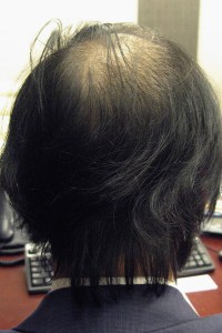 view from back 5 weeks from transplant