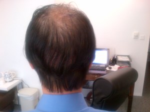 Day 2 after operation: view from behind is much better after washing the hair and blowing dry with cool wind.