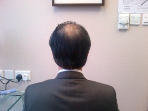 Day 4 view from the back after hair washing.