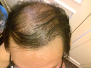 Day 4 vVew from the top before washing, healing well.