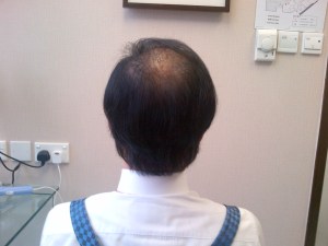 Day 5 view from back after wash and blow dry.