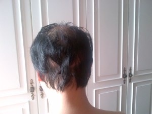 Day 5 view from behind before hair wash: slight matting of hair after a night's pressure.