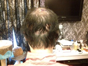 View from behind, mainly donor site, but covered by hair.  View possible because it was difficult to wash & dry hair for tidiness very early.