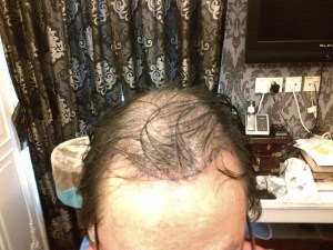 Appearance from front-top, mainly recipient site for hair viewable from the front.