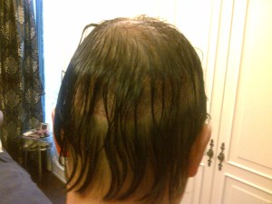 Day 2 view from behind, The donor site was hidden behiind hair which was deliberately allowed to grow long so as to cover the donor site so illustrated.