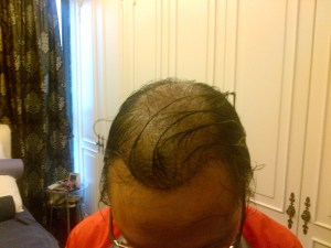 View from the front & above, mainly showing donor site.  