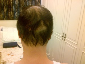 Day 3 view from back before hair washing, showing donor site through 'windows' caused by hair sticking to one another.