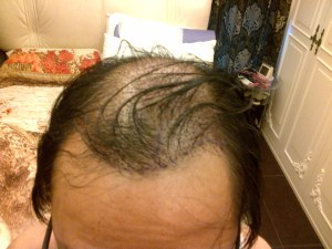 Day 3 front-view to show recipient site.