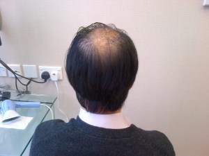 Day 3 view from back after hair washing.  Tidy and naturally looking now. Donor site covered well.