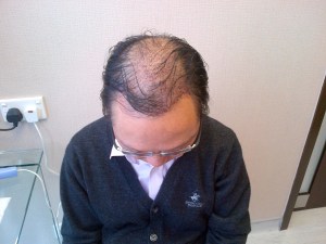 Day 3 view on top after hair washing, showing recipient site. 