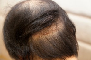 Donor site on Dec 21, shown with hair pushed aside.  Healthy and recovered.