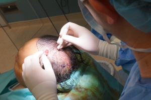 Implantation of hair follicle one at a time