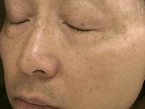 Left side of face Aug 20 2013